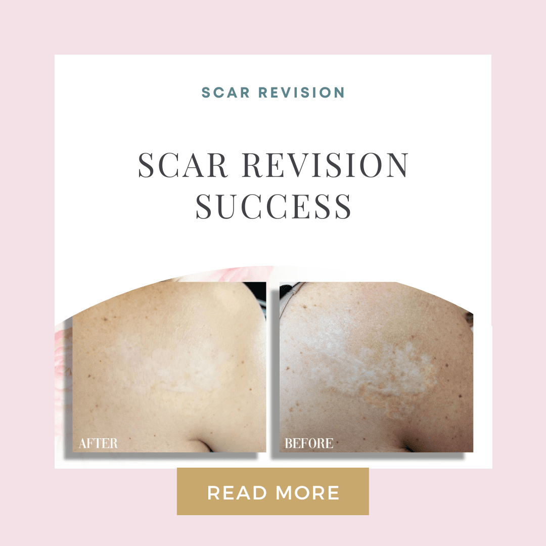 Scar Revision Success