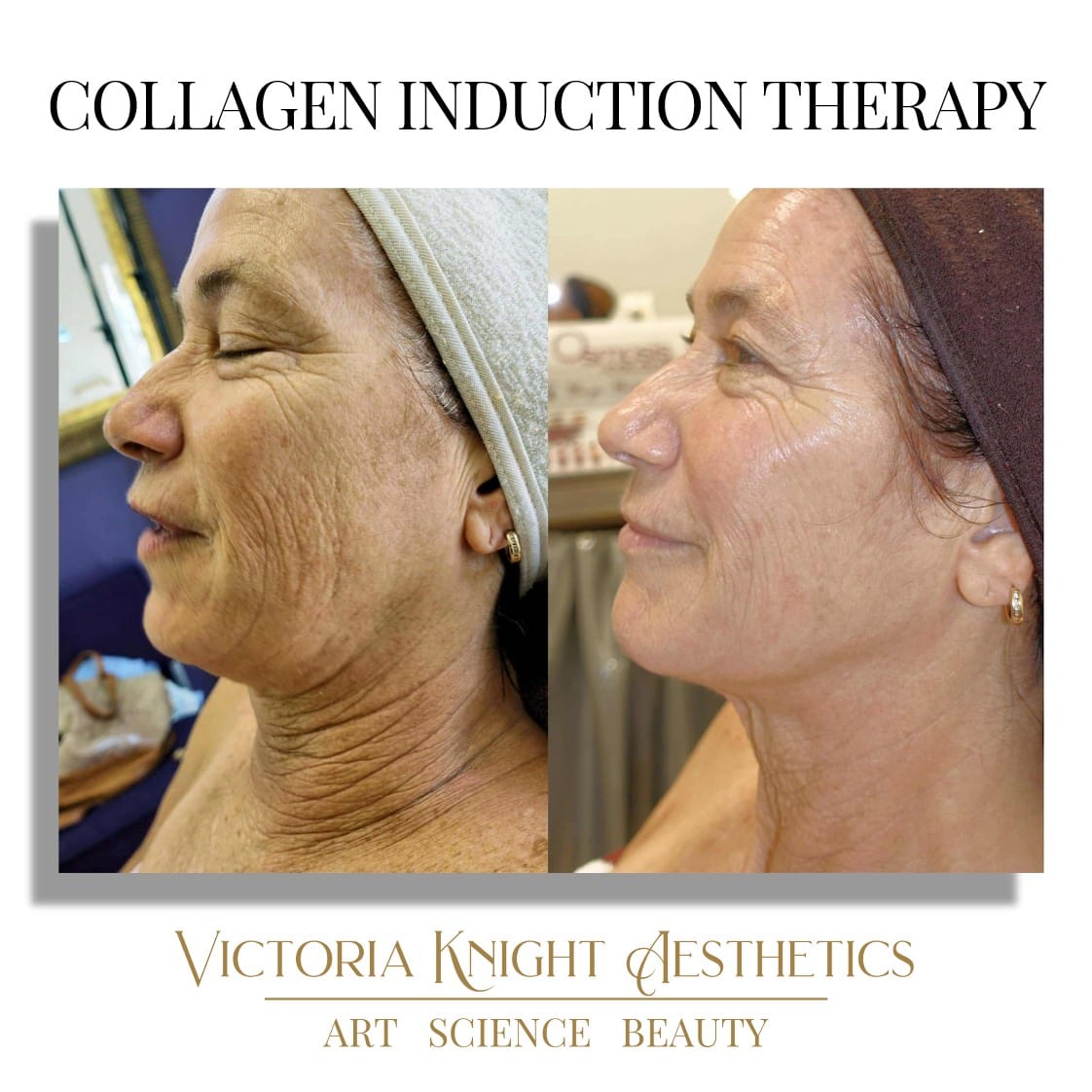 Collagen Induction Therapy Before and After