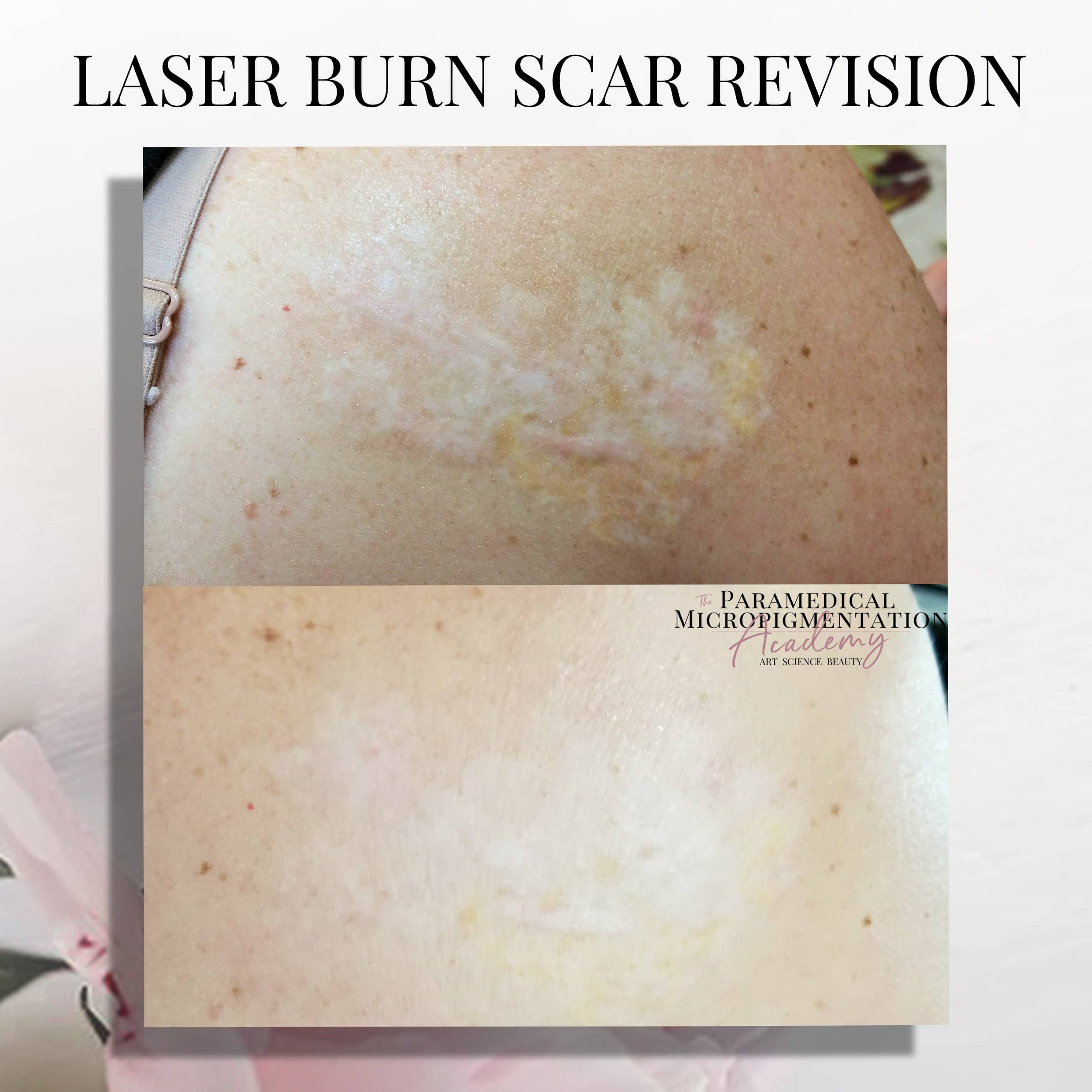 Laser Burn Scar Revision